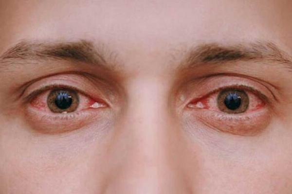 دلایل اصلی قرمزی چشم چیست؟